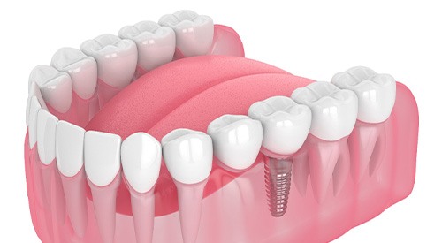 Illustration of single dental implant
