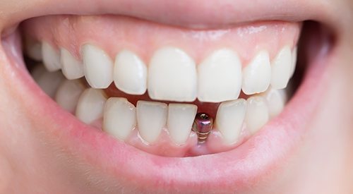 Closeup of a dental implant