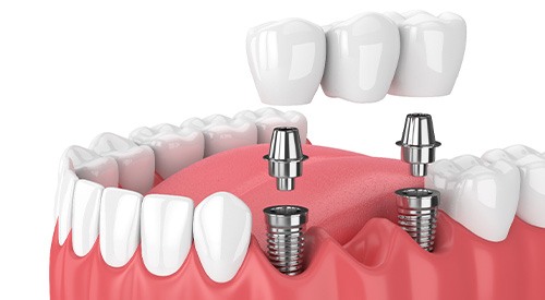 Illustration of implant bridge