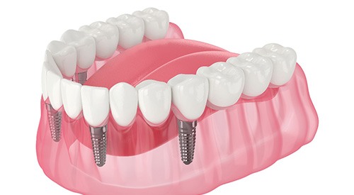 Illustration of implant denture