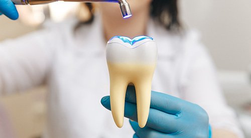 Dentist demonstrating bonding with large model toothDentists applying UV light to woman’s dental bonding