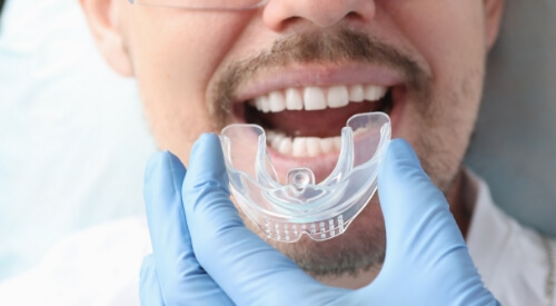 Man in dental chair being fitted for a nightguard