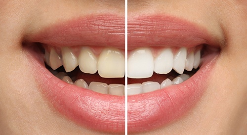 Smile that’s half whitened to show before/after results