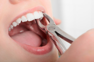 Close-up of patient having a tooth extracted