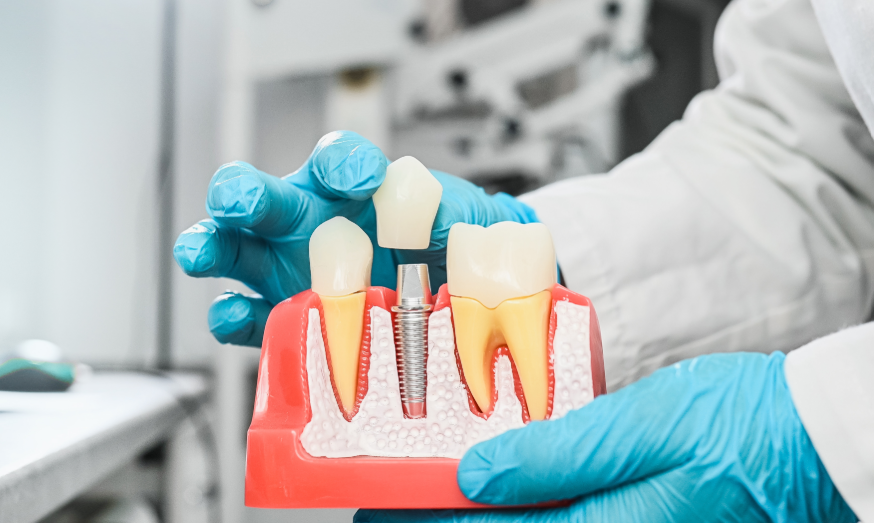 Dentist holding model dental implant