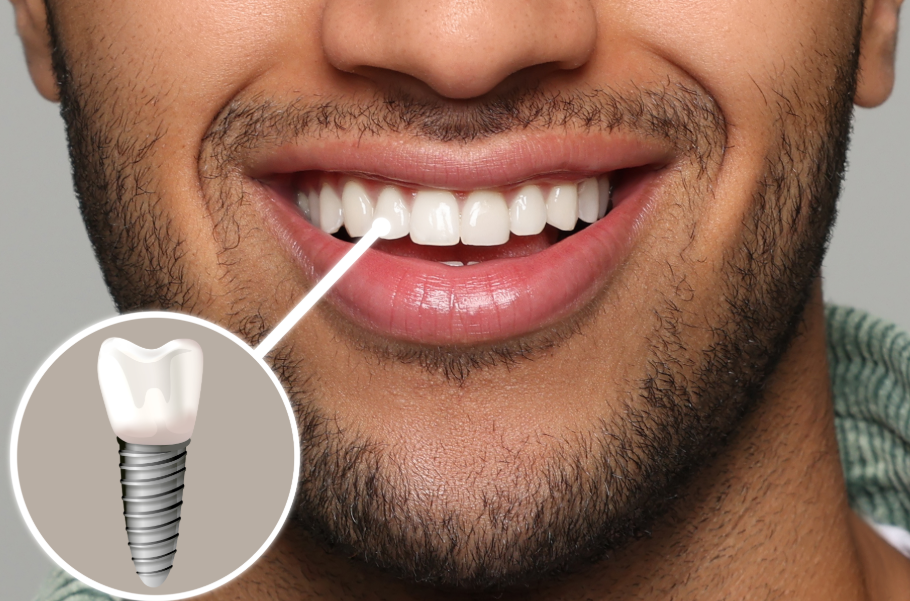 Close up of man's smile with dental implant